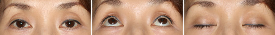 眼瞼下垂症/症例１/手術前