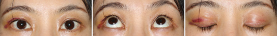 眼瞼下垂症/症例２/手術後５日目