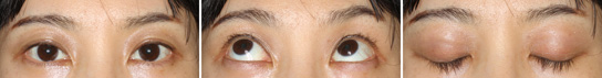 眼瞼下垂症/症例２/手術後１か月目
